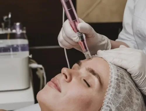 Advanced Laser Treatments for Skin Perfection