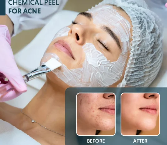 Chemical-Peel-for-Acne
