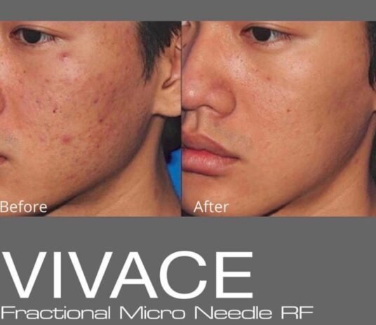 MNRF- Microneedling Radio Frequency – Vivace treatment