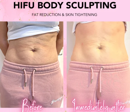 HIFU-Skin Tightening