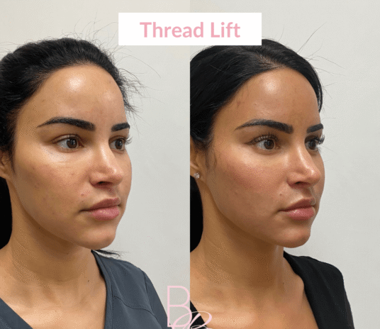 Threadlift-treatment-in-nagpur