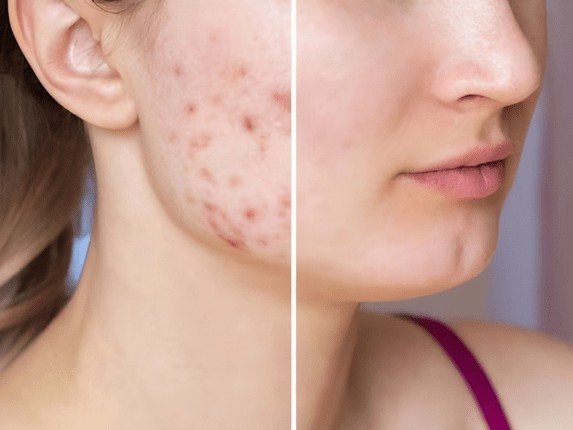 Acne & Acne Scar Treatment