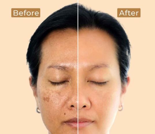 depigmentation-gel-feature-img-01 (1)