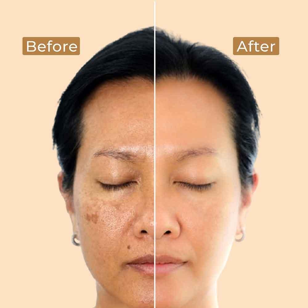 Pigmentation