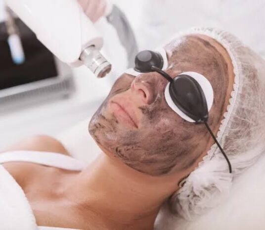 Carbon Peel- Tribeam Laser treatment