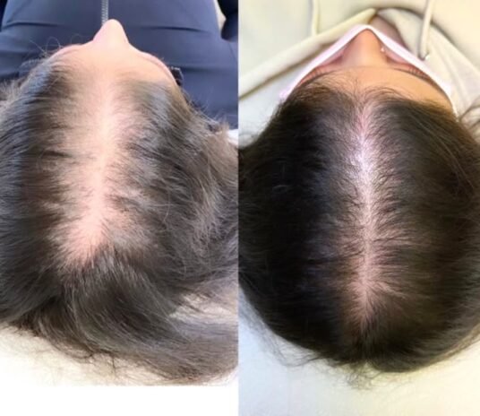 This is the client’s hair after 5 sessions of the Needle-Free PRP with Jet Peel treatment 🔥 This result is just unbelievable 😍 It is a needleless injection for hair regrowth_ This
