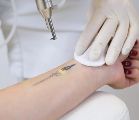 tatto-removal-in-pune